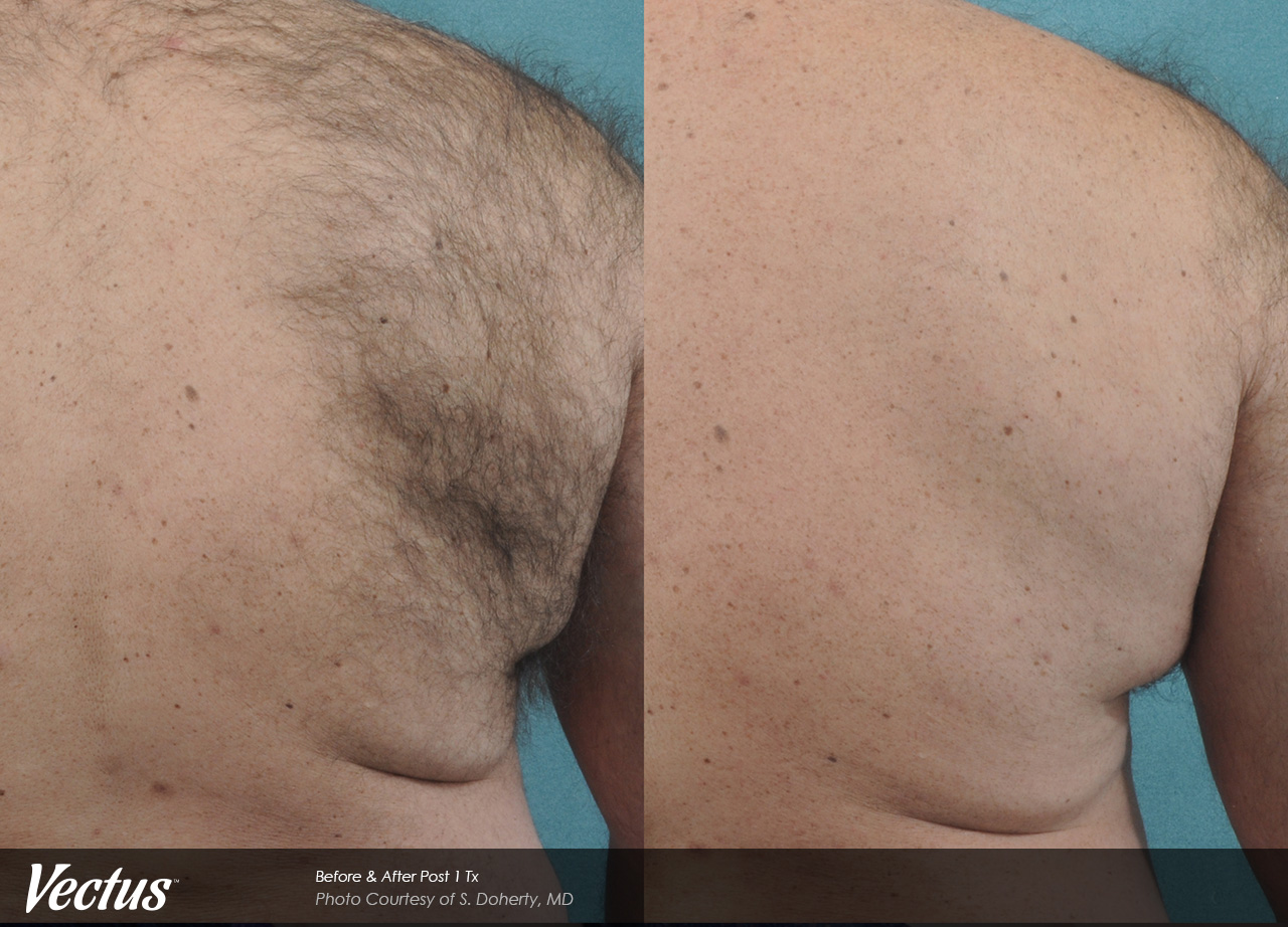 Laser Hair Removal Baroody Plastic Surgery