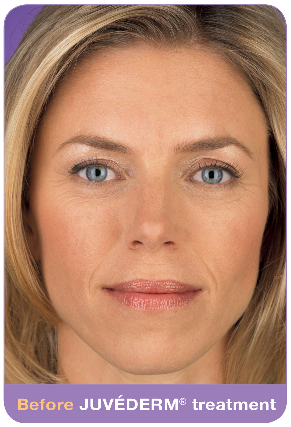Juvederm_Before_and_After_Photo