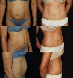 Abdominoplasty  Age: 44 Height: 5'3" Weight: 121 lbs. 