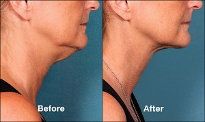 Before and After 2 KYBELLA