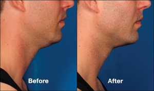 Before and After 3 KYBELLA