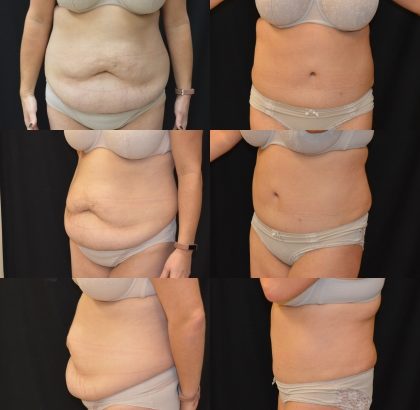 Tummy Tuck - Baroody Plastic Surgery